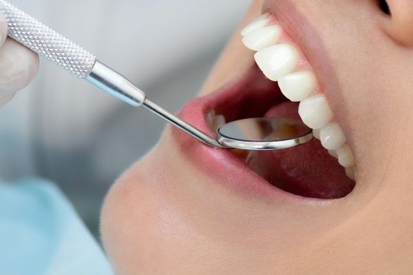 Broken or Chipped Tooth Repair