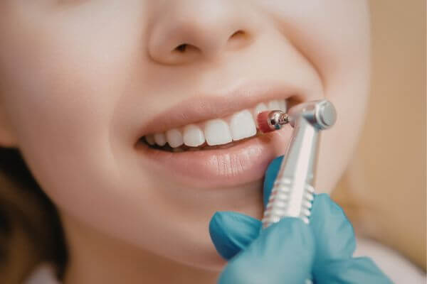 Dental Sealants for Kids