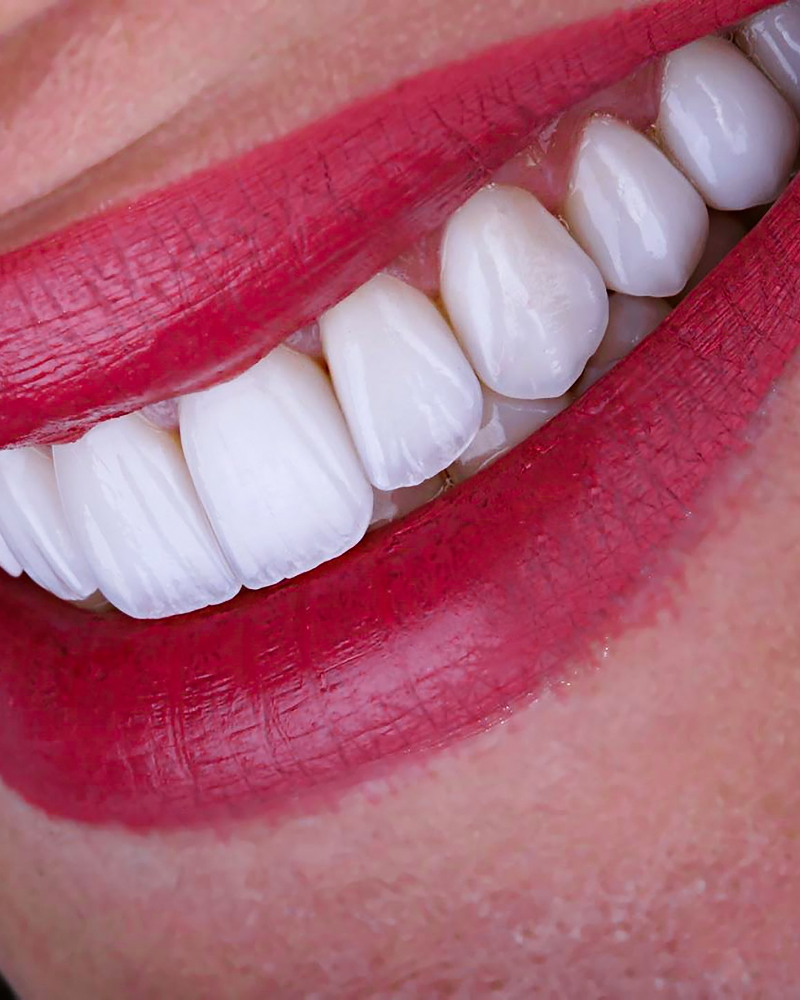 Porcelain veneers