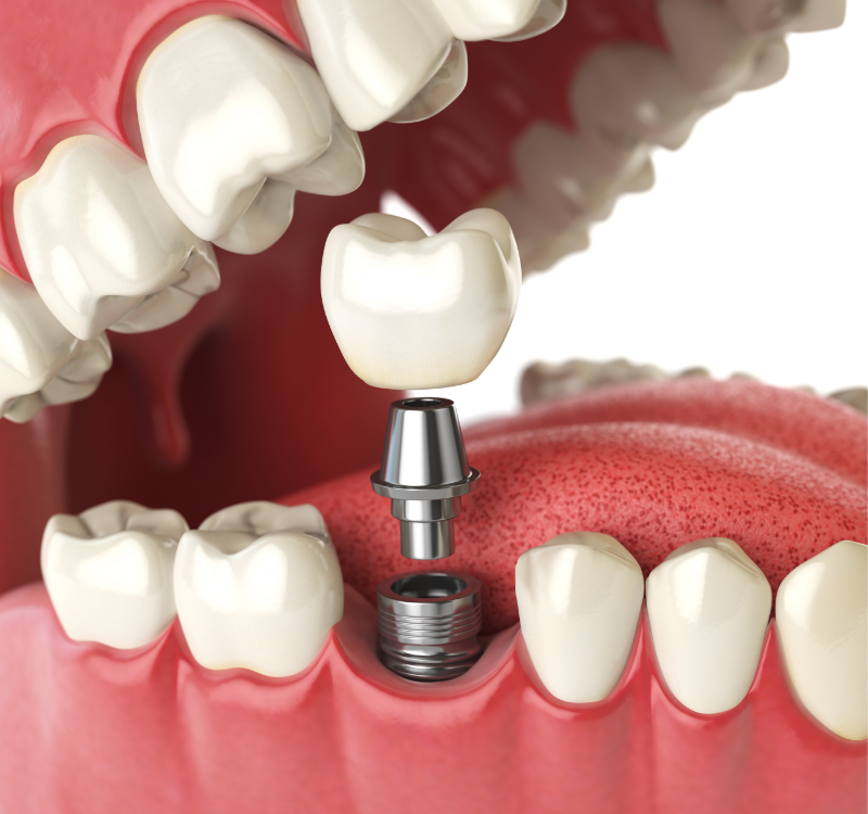 dental implants 2